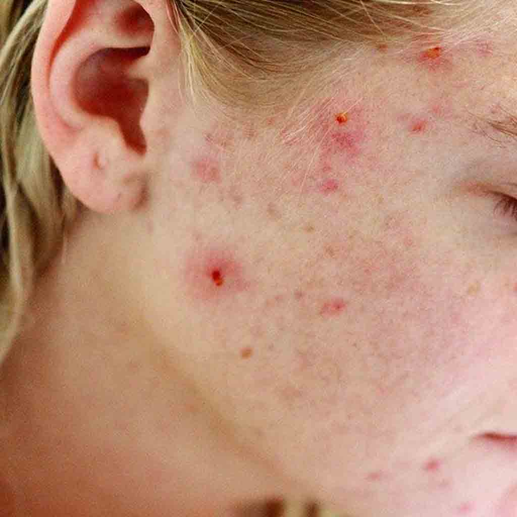 A lady with acne eruptions that is causing inflammation and psychology disturbance and how Jamila Products can help maintaining healthy habits