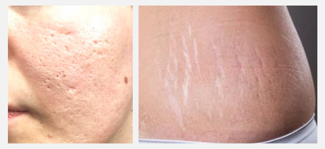 Scars Formation and Treatment: Simple Things at home till laser procedures at dermatology clinics