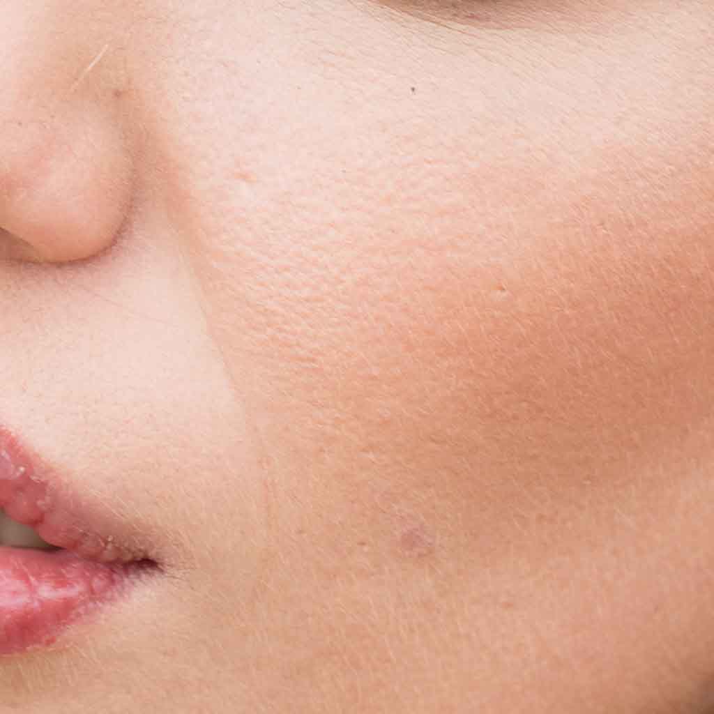 Enlarged Pores