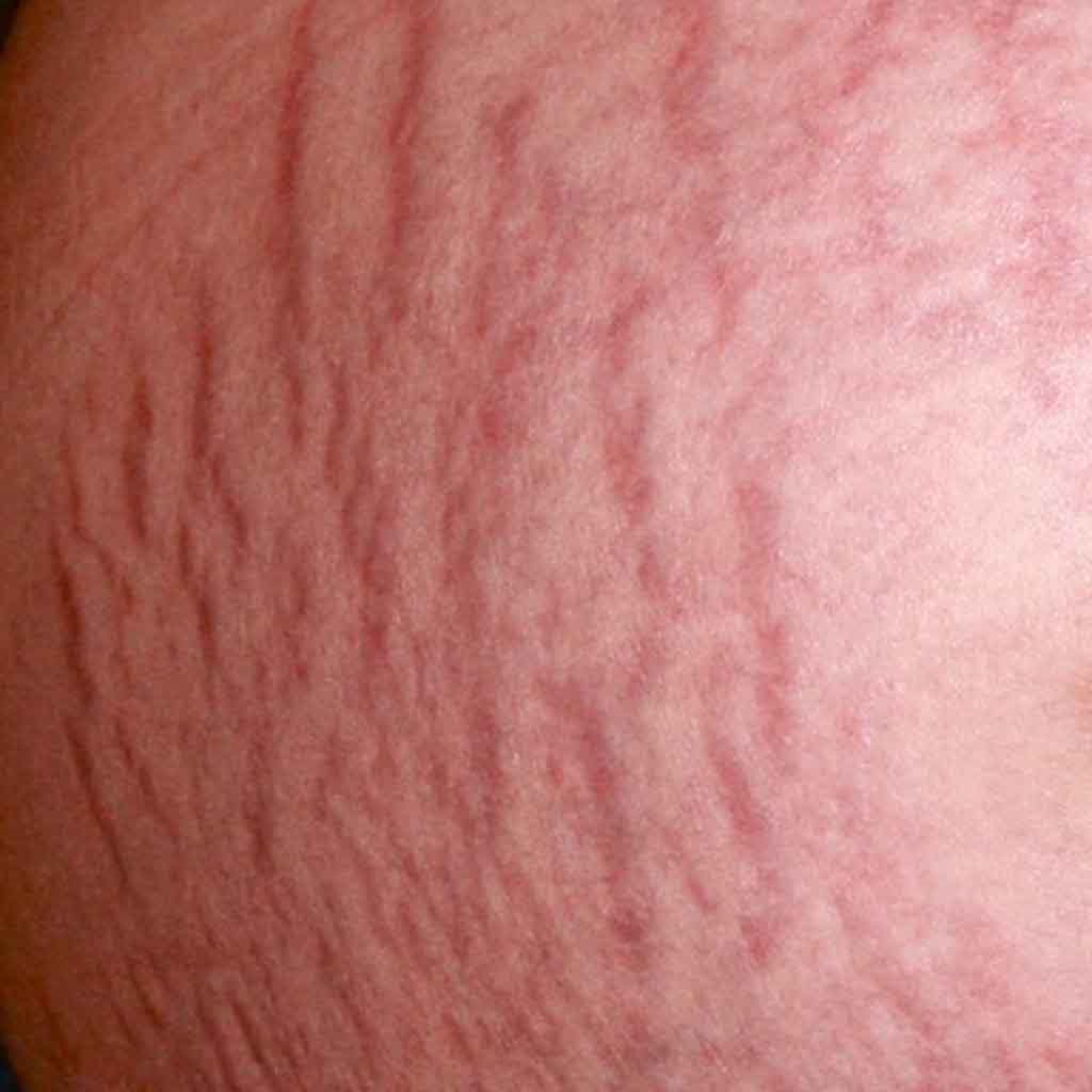 Stretch Marks photo that represents reddish scar on the abdomen